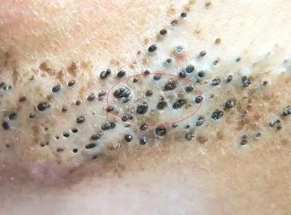 脸上螨虫怎么去除用什么药_去螨虫的最有效的药膏