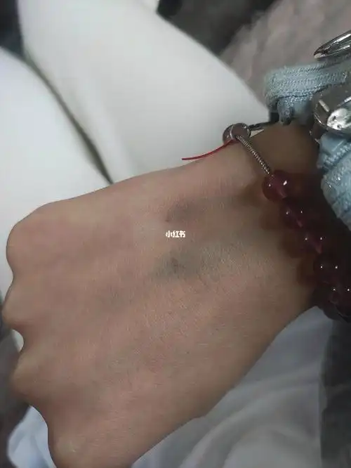 有和我一样的一打点滴都是青紫的吗   医生都没血管扎针了