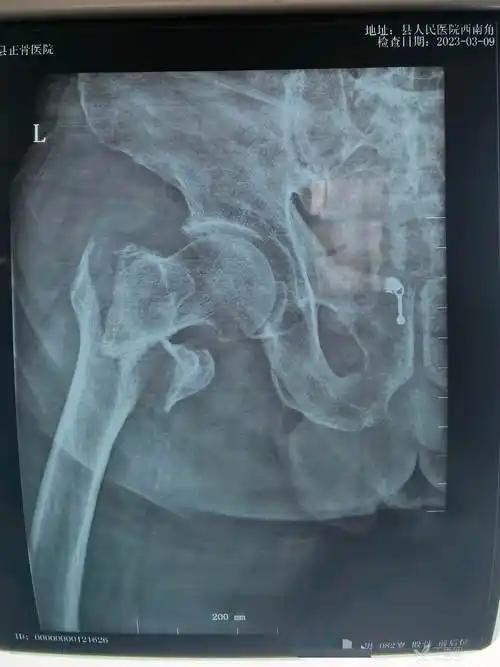 这样的一例股骨转子间骨折你会怎么复位 - 丁香园论坛