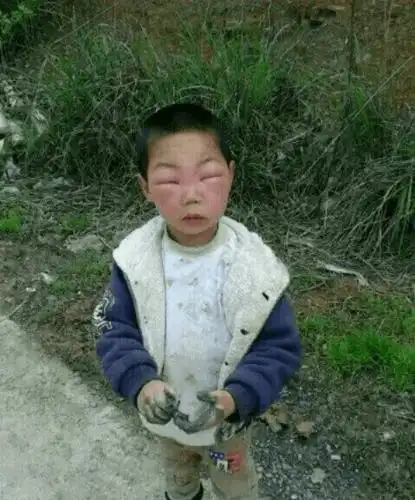 孩子,眼睛都蛰成这样了,还在玩?