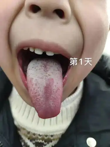 小儿积食地图舌