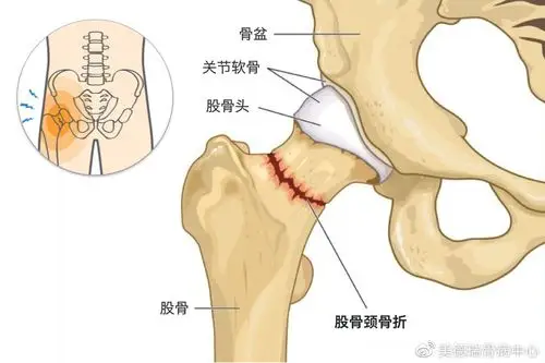 老年人股骨颈骨折一定要做手术吗