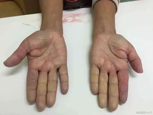 医院库 北京西京中医医院 疾病知识 雷诺氏病主要有什么危害?