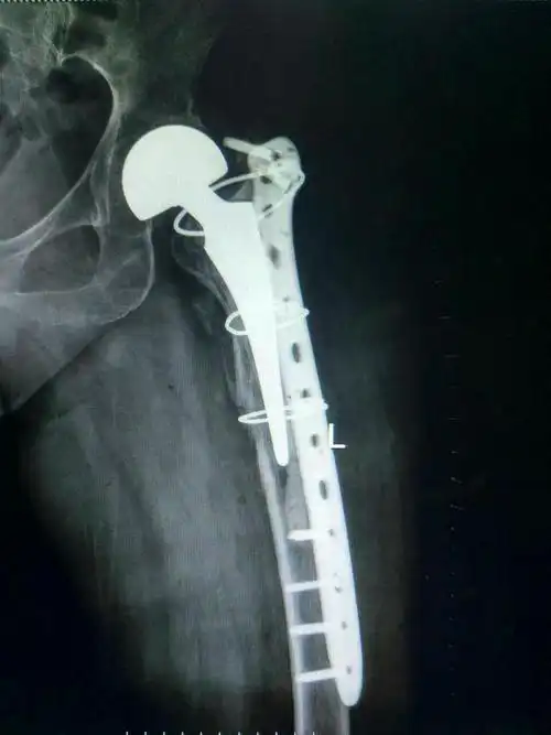 郑州市骨科医院创伤外科——关于人工股骨头假体周围骨