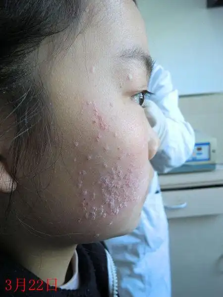 艾拉光动力治疗扁平疣照片展示 - 好大夫在线