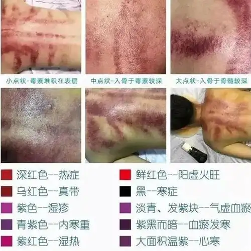 当然,刮痧不是一定会出痧以下四类人群是不容易出痧的:①身体健康者仅