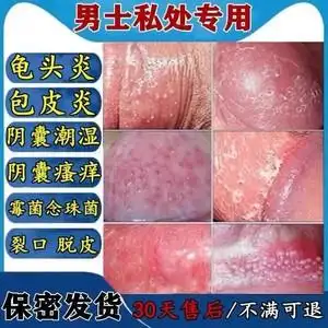 龟头炎的药膏裂口霉菌性包皮炎症白色念珠菌红点阴茎瘙痒71人付款59
