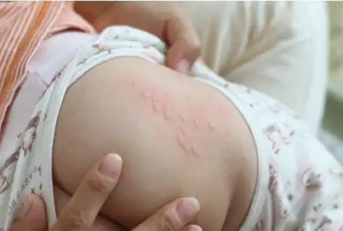 【婴儿风疹图片】_风疹症状_治疗_苹果绿