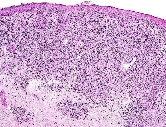 皮肤临床病理08蕈样霉菌病