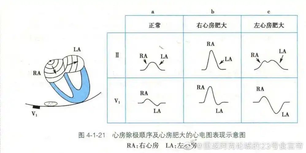 从"肺心病"读懂心电图