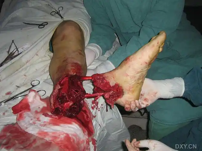 左小腿绞拌机致完全离断伤,这个肢体还能保吗?(能,续图) [精华]