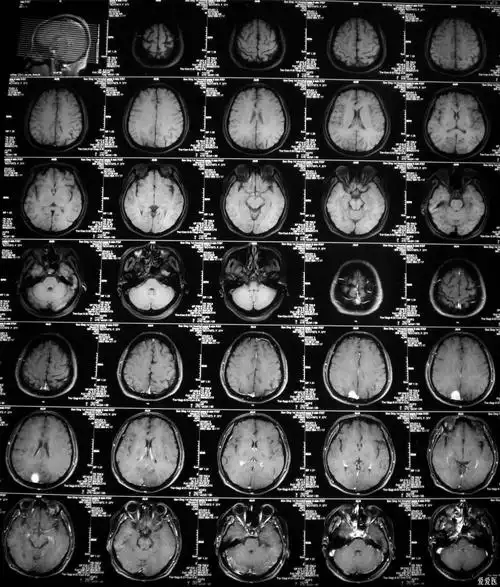 矢状窦旁多发占位脑膜瘤