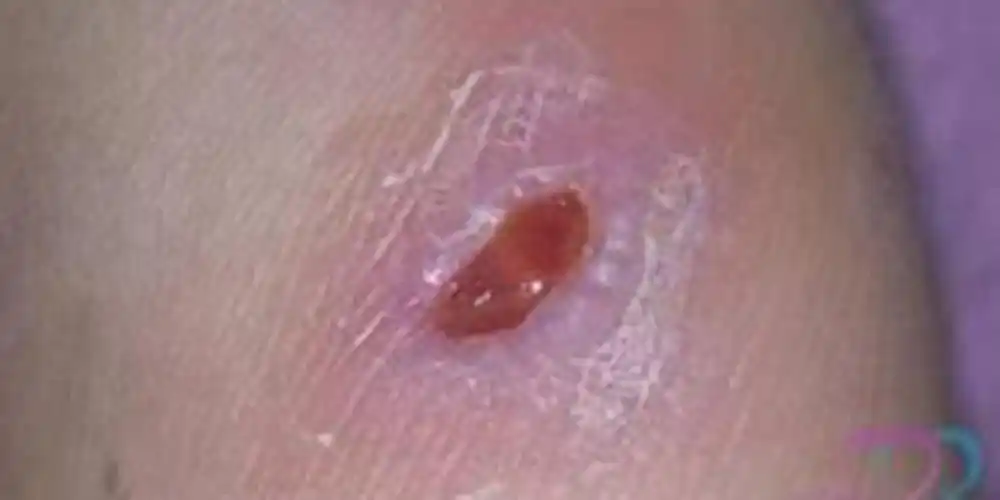 男性症状淋病阴部图片 _有来医生