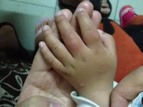 手上长肉刺怎么才能彻底根治