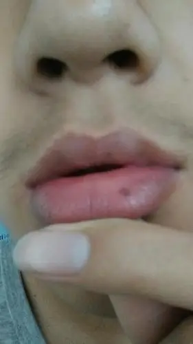 嘴唇上的黑点,好几年了