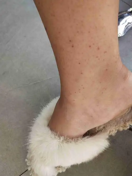 脚背起小红点 不疼不痒 一个多月了
