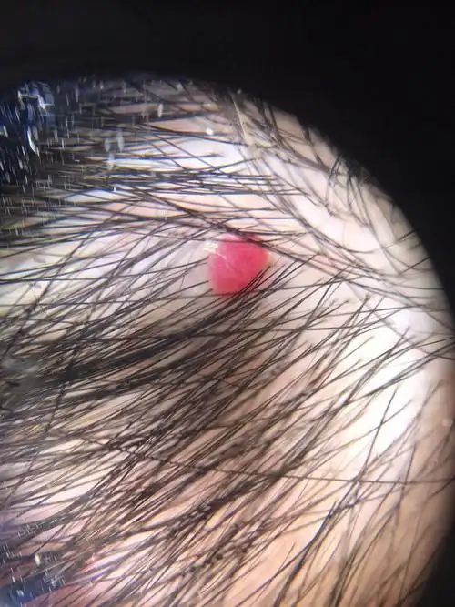 樱桃一样的血管瘤,怎么办