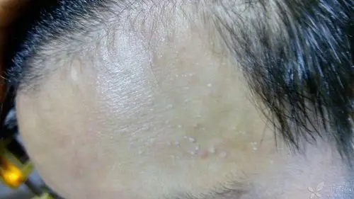 相关疾病: 疣 是脂肪粒还是疣?长在额头两侧都有是白色的