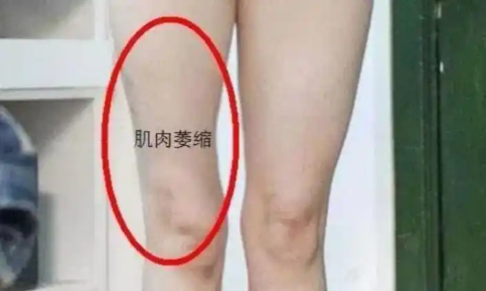 肌肉萎缩后如何处理?