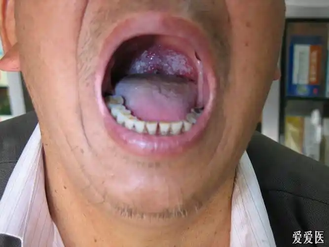 65岁男性 霉菌性口腔炎(治疗效果图片已经上传)