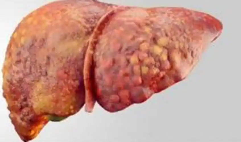 酒精肝的损伤症状的图片