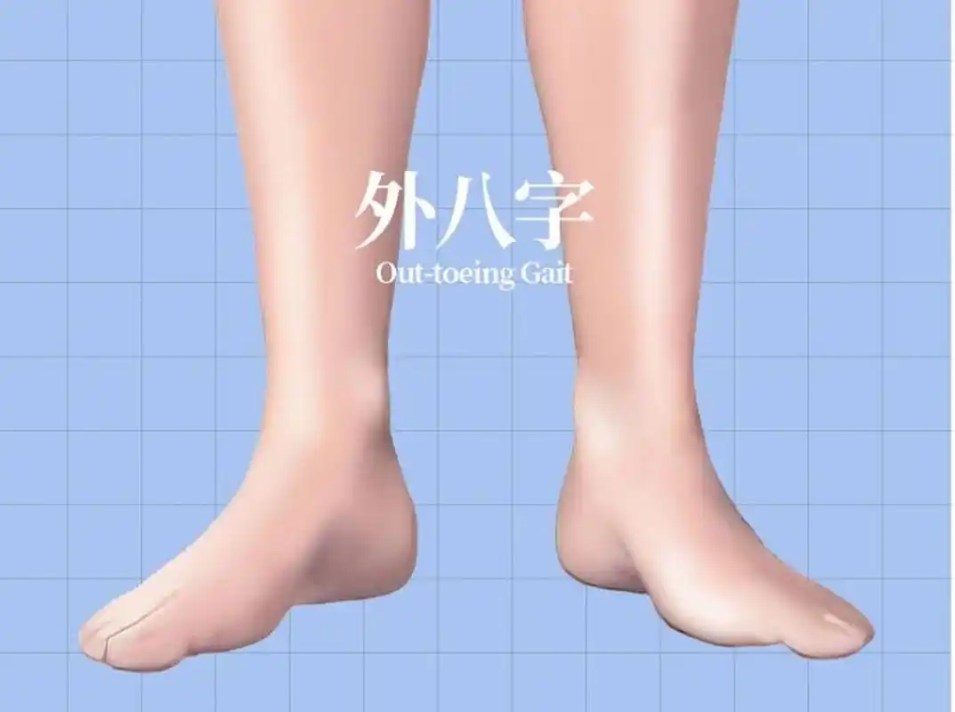 1,走路姿势不美观,还会使下肢肌肉力量不平衡,导致骨骼,肌肉形态的