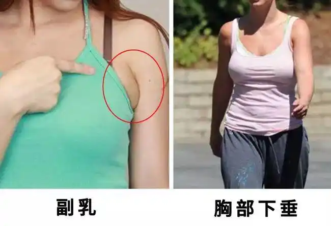 乳头发炎   都是跟文胸材质不洁导致的      而没有钢圈的内衣虽然