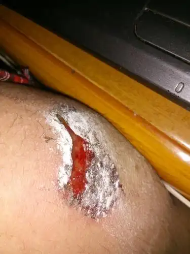 问:我的伤口可以用红药水吗?如果可以怎么用,如果不可以该用什么药