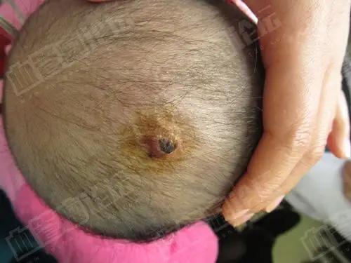 婴儿头部毛细血管瘤治疗日记