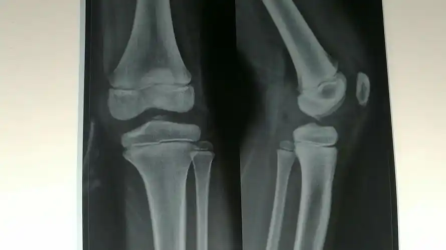 胫骨髁间嵴骨折一例