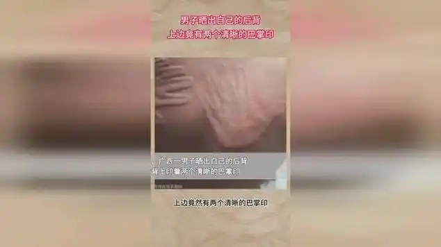 男子晒出自己的后背 上边竟有两个清晰的巴掌印|奇葩事件|社会趣闻