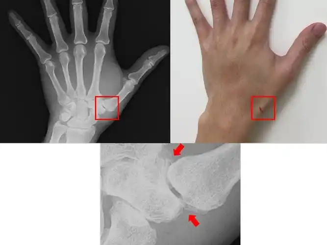 经x光摄影发觉拇指腕掌关节退化并骨刺增生的情形(图片/台大竹东分院