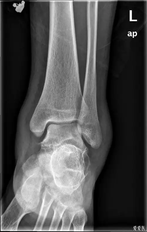 左距骨骨折_1002_1001.jpg