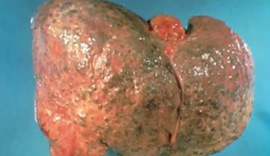 酒精肝的损伤症状的图片