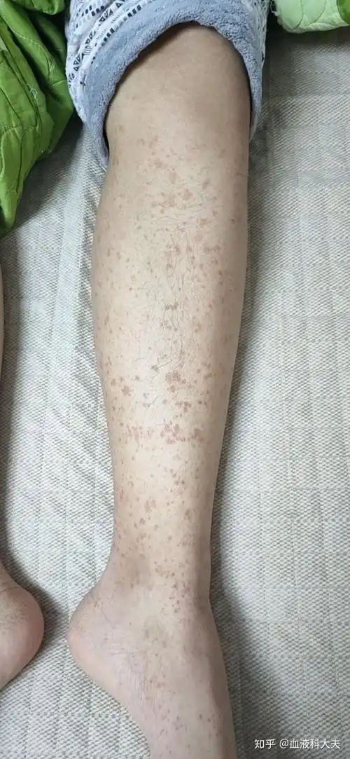 8岁得了过敏性紫癜