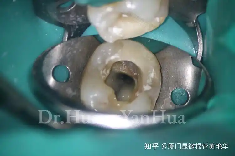 龋坏的牙洞内长息肉治疗牙髓息肉一例