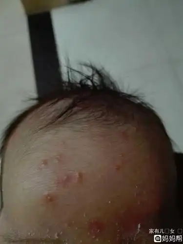 婴儿湿疹分为渗出型和干燥型,症状有所不同渗出型湿疹高发于比较肥胖