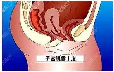 子宫脱垂1度的样子