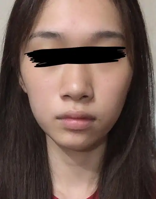 脸型崎岖不对称怎么办