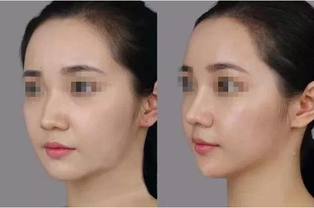 鼻部整形手术_鼻部整形医院_鼻子整容多少钱_形美网