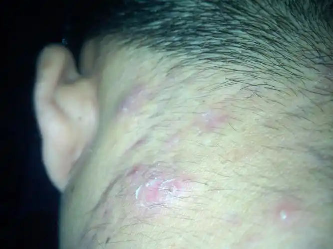 起粉刺很大很硬很大胸口背部都张满了