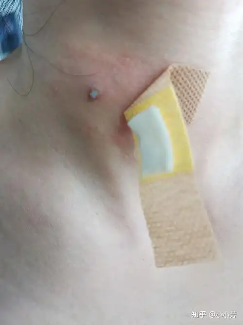 白醋祛除丝状疣