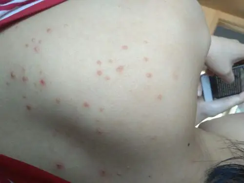 网友吗看下我对象后背起了这些小疙瘩,谁认识这是什么皮肤病?