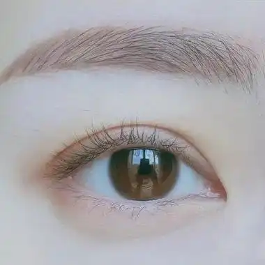 做双眼皮的第四天,想问一下是没有消肿还是割坏了?