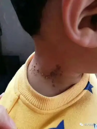 孩子感染病毒疣的原因究竟有哪些?