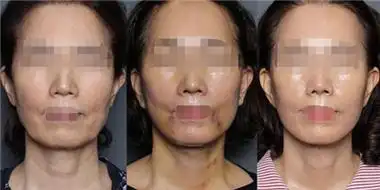 大拉皮手术前后对比