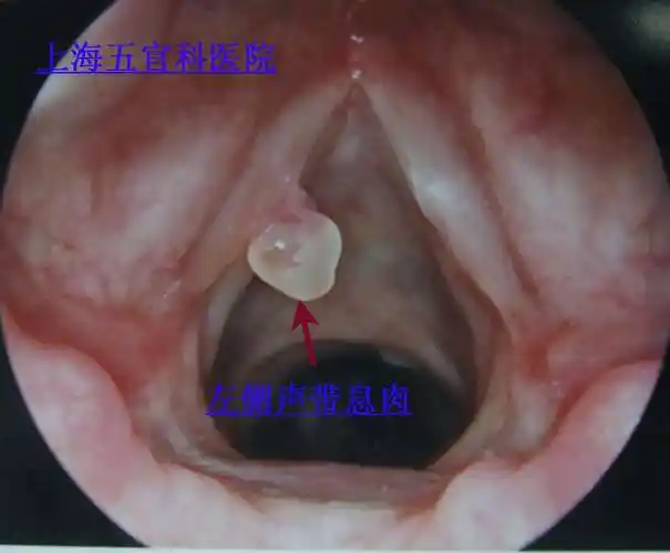 要手术治疗的声带息肉图片