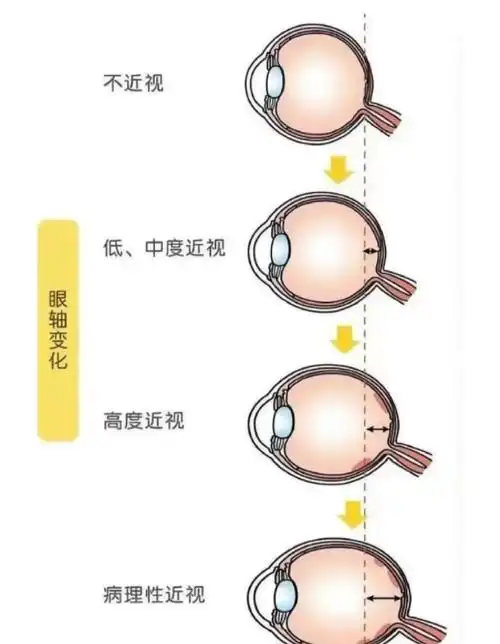 近视的眼睛