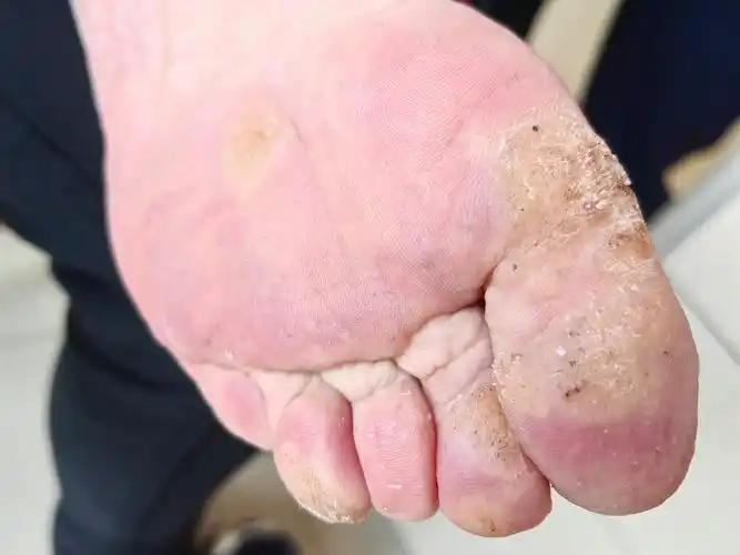 一群病毒疣其乐融融,就成了镶嵌疣.