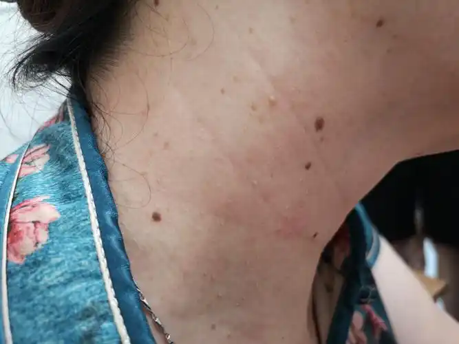 维生素c/e,β胡萝卜素等抗氧化剂对于减缓皮肤老化有帮助,所以对减少